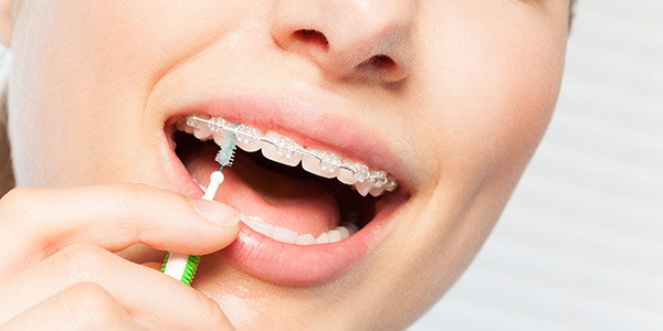 Les brossettes inter dentaires sont utiles pour nettoyer les appareils orthodontiques